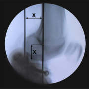 Knee rotation center