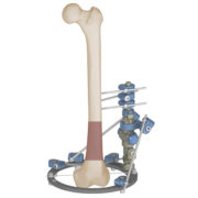 Monolateral fexator femur distal fracture