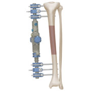 Monolateral fixator tibia diaphyseal fracture
