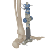 Montaggio su caviglia